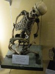 An adult with a rare bone desease
