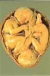 Wax model of twins